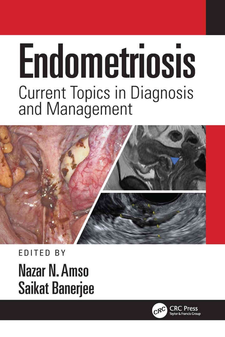 Endometriosis: Current Topics in Diagnosis and Management eBook