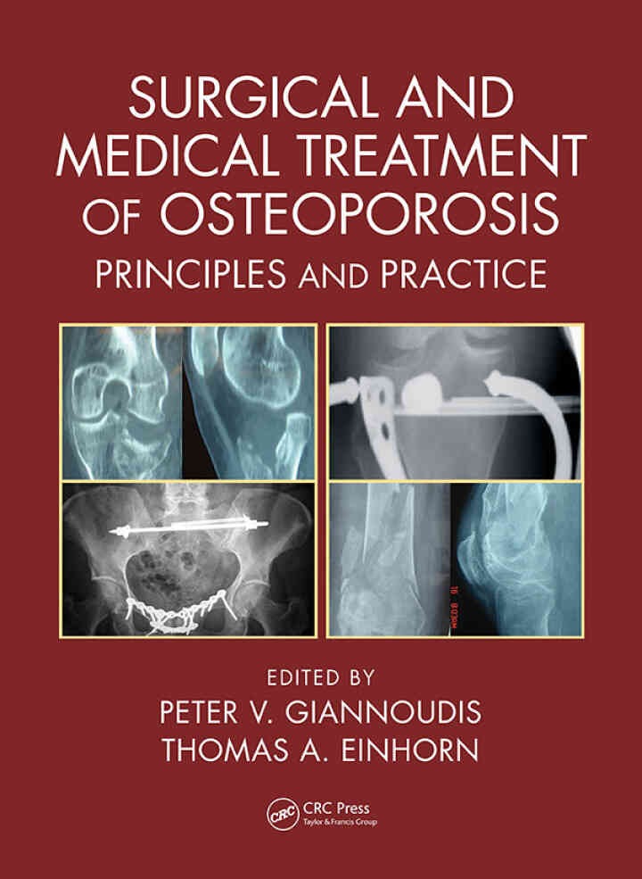 Surgical and Medical Treatment of Osteoporosis: Principles and Practice, 1st Edition eBook